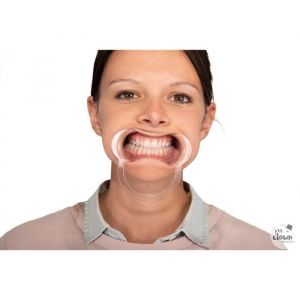 Ruedelafete Lot de 4 écarteurs de bouche