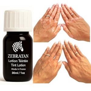 Lotion Maquillage Vitiligo 30 ml &ndash; Masque les Taches Blanches sur la Peau &ndash; Camouflage Naturel Non Gras pas un fond de teint &ndash; Hommes, Femmes & Enfants &ndash; Autobronzant, Vegan &ndash; Teinte beige marron (Zebratan, neuf)
