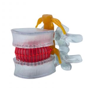 Modele de hernie discale lombaire Modele mobile de la colonne lombaire montrant une protrusion discale lombaire pathologique Disque et nerf normaux - Neuf