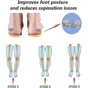 Semelles Orthopediques Pour Supination Et Soutien De La Voute Plantaire, Inserts Orthopediques Pour L'alignement Du Pied, Knoc - Neuf